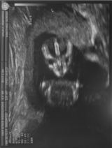 Ultrasound